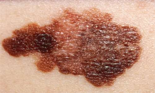 I tatuaggi possono dar vita a melanomi