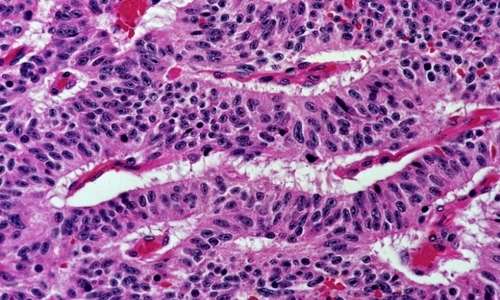 I carcinomi causati da cellule non piccole (NSCLC) colpiscono in maniera maggiore la popolazione maschile e rappresentano la quota maggiore dei tumori polmonari. Recenti studi hanno evidenziato che per svilupparsi i tumori polmonari preferiscono l'acido lattico al glucosio.