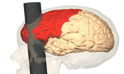Il cervello di Phineas Gage fu colpito dall'asta di ferro che gli trapassò il cranio, causando la perdita di parte del lobo frontale sinistro
