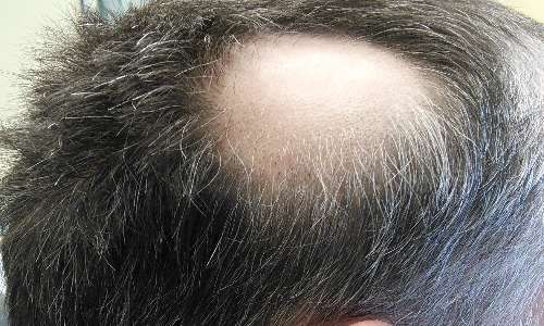 L'alopecia è un carattere principalmente maschile. Il cromosoma x insieme all'y è un cromosoma sessuale.