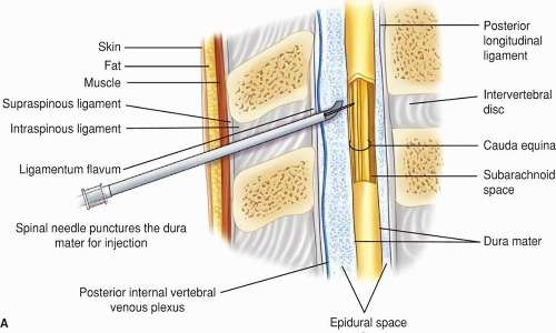 la stimolazione epidurale consiste nell'inserimento dell'elettro nello spazio epidurale