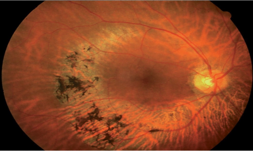 La protesi retinica prima di essere impianta ha bisogno di un esame del fundus oculare.