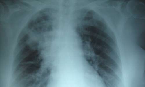 La fibrosi cistica colpisce i polmoni, ostruendo le vie aeree con un accumulo di muco.
