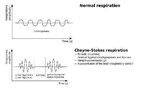 respiro-di-Cheyne-Stokes grafico respirazione normale e anomala