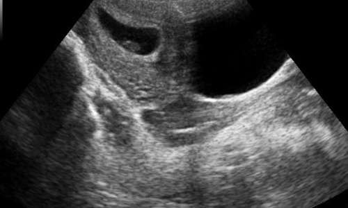 ultrasuoni ecografia