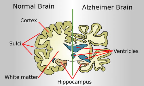 La neurodegenerazione, tipica del morbo di Alzheimer, è causata dalle placche senili e dalla degenerazione neurofibrillare.