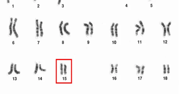 Cariotipo umano con i 23 paia di cromosomi; il cromosoma 15 è evidenziato in rosso.